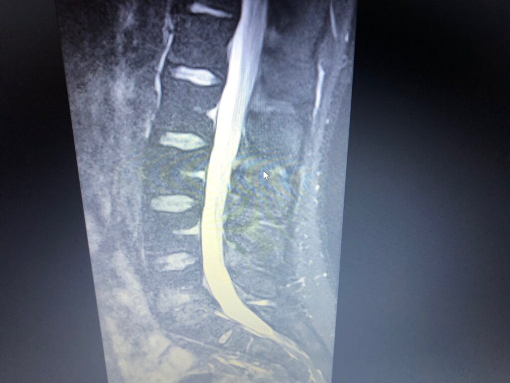 liečba chrbtice bez operácie