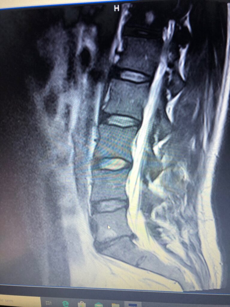 Degeneratívne zmeny na chrbtici, poškodenie medzistavcových platničiek - 
pred terapiou